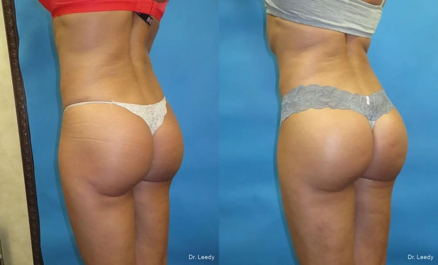 Brazilian Butt Lift: Patient 6 - Before and After 7