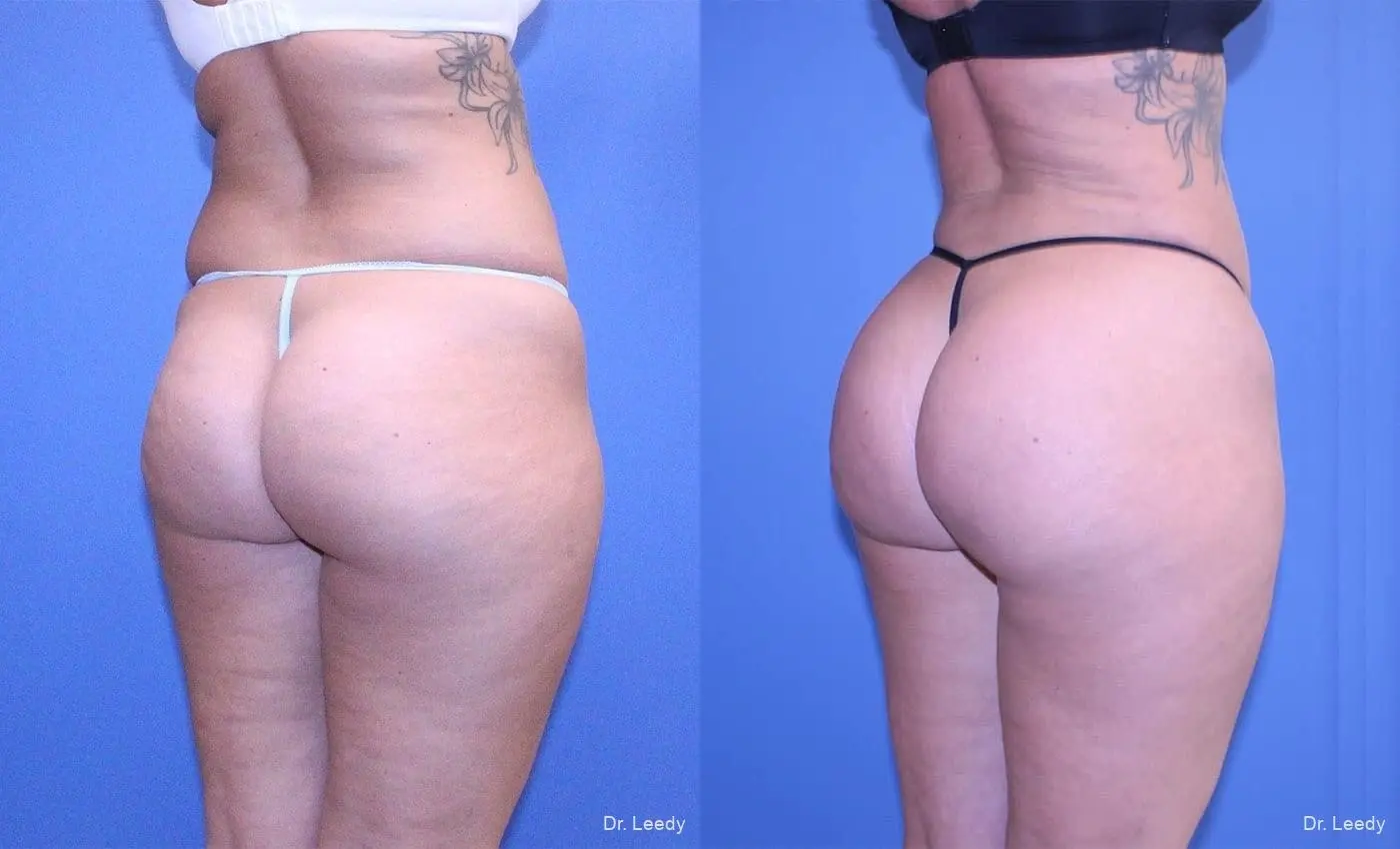 Brazilian Butt Lift: Patient 8 - Before and After 4
