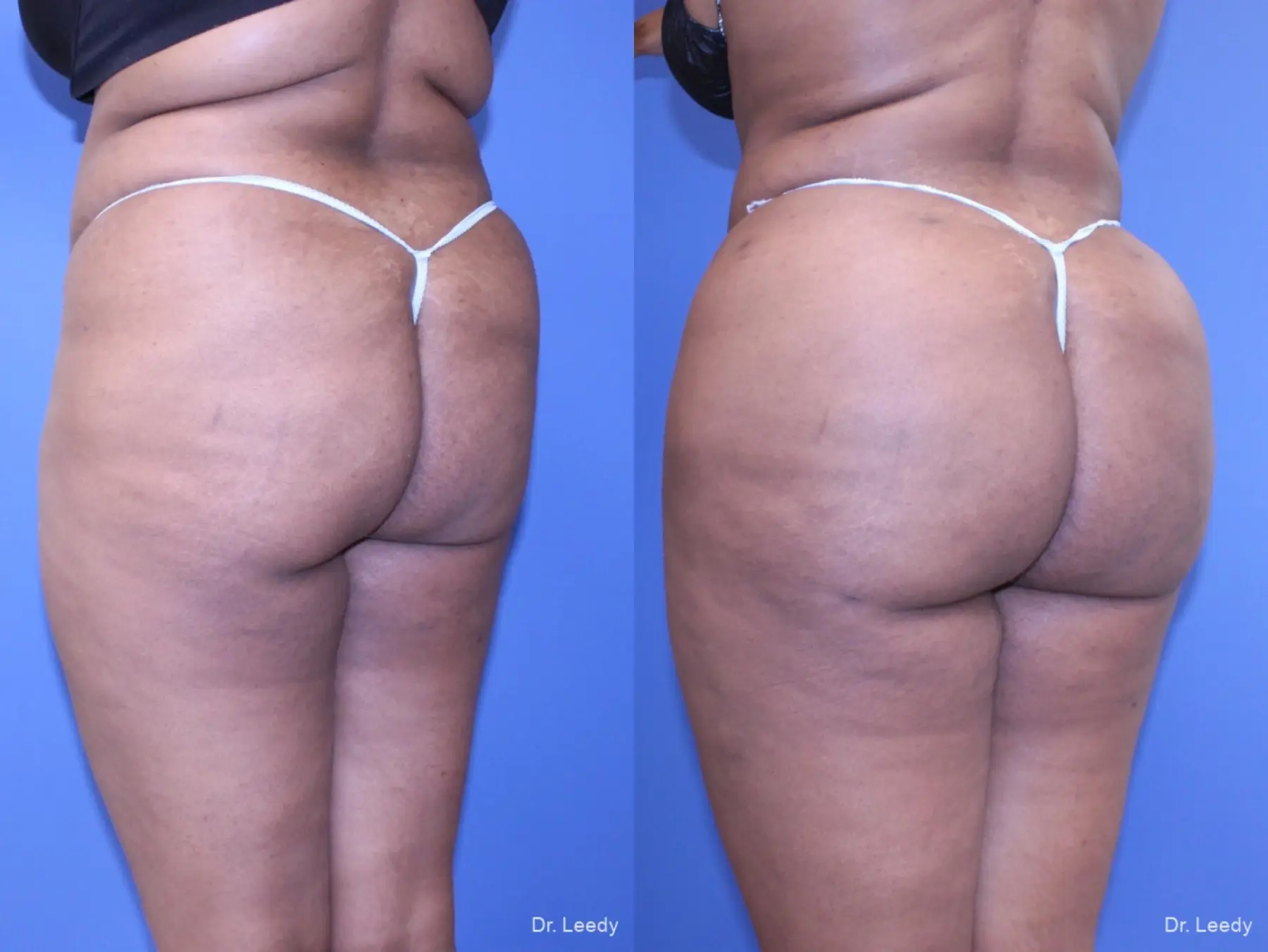 Brazilian Butt Lift: Patient 5 - Before and After 2