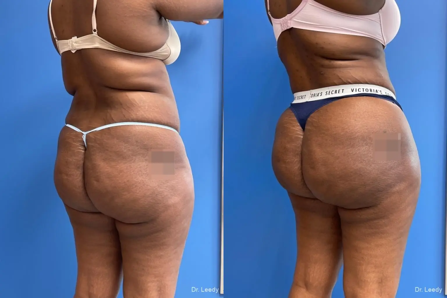 Brazilian Butt Lift: Patient 4 - Before and After  