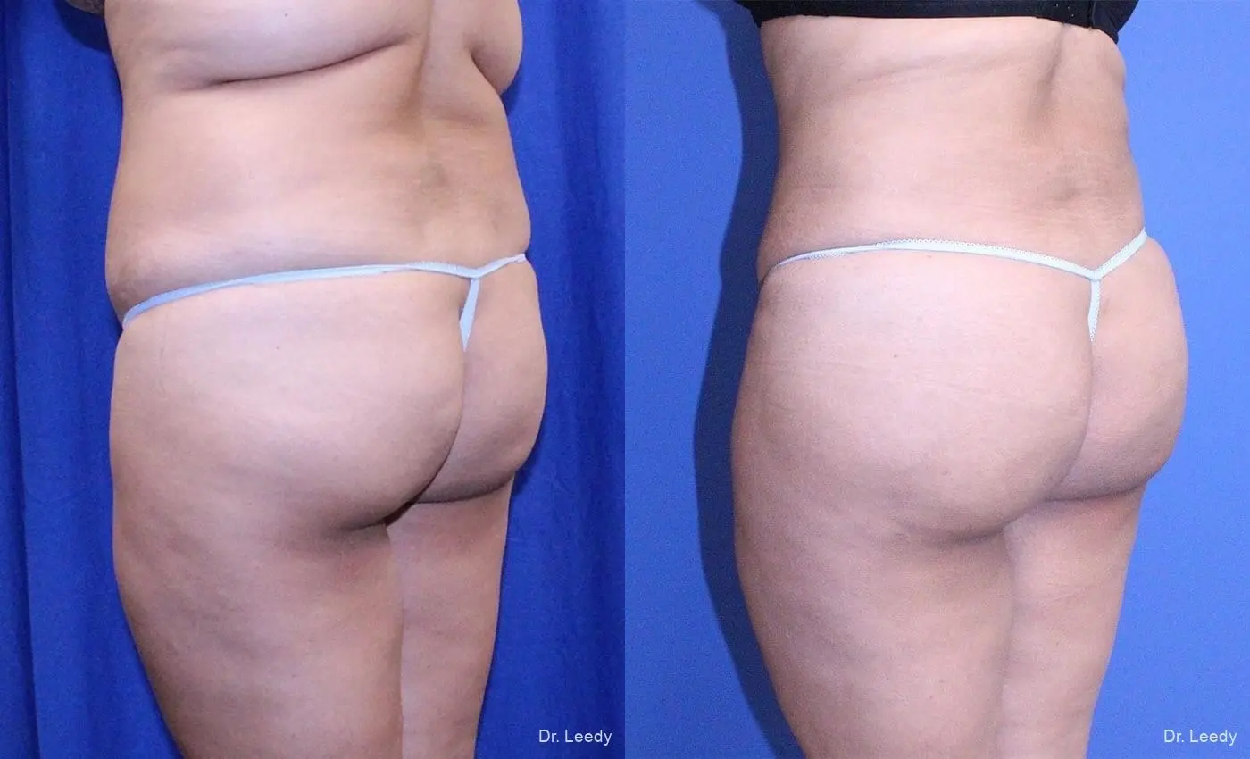 Brazilian Butt Lift: Patient 4 - Before and After 5