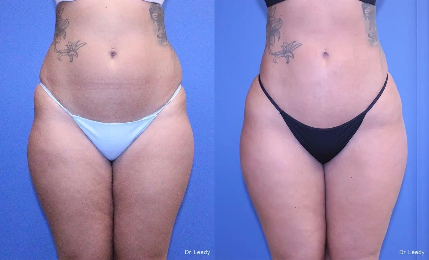 Brazilian Butt Lift: Patient 8 - Before and After 2