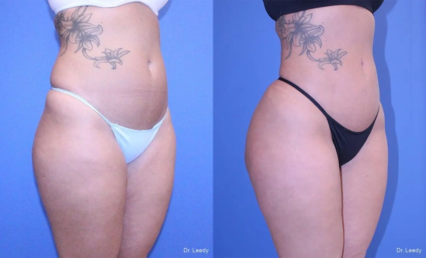 Brazilian Butt Lift: Patient 8 - Before and After 3