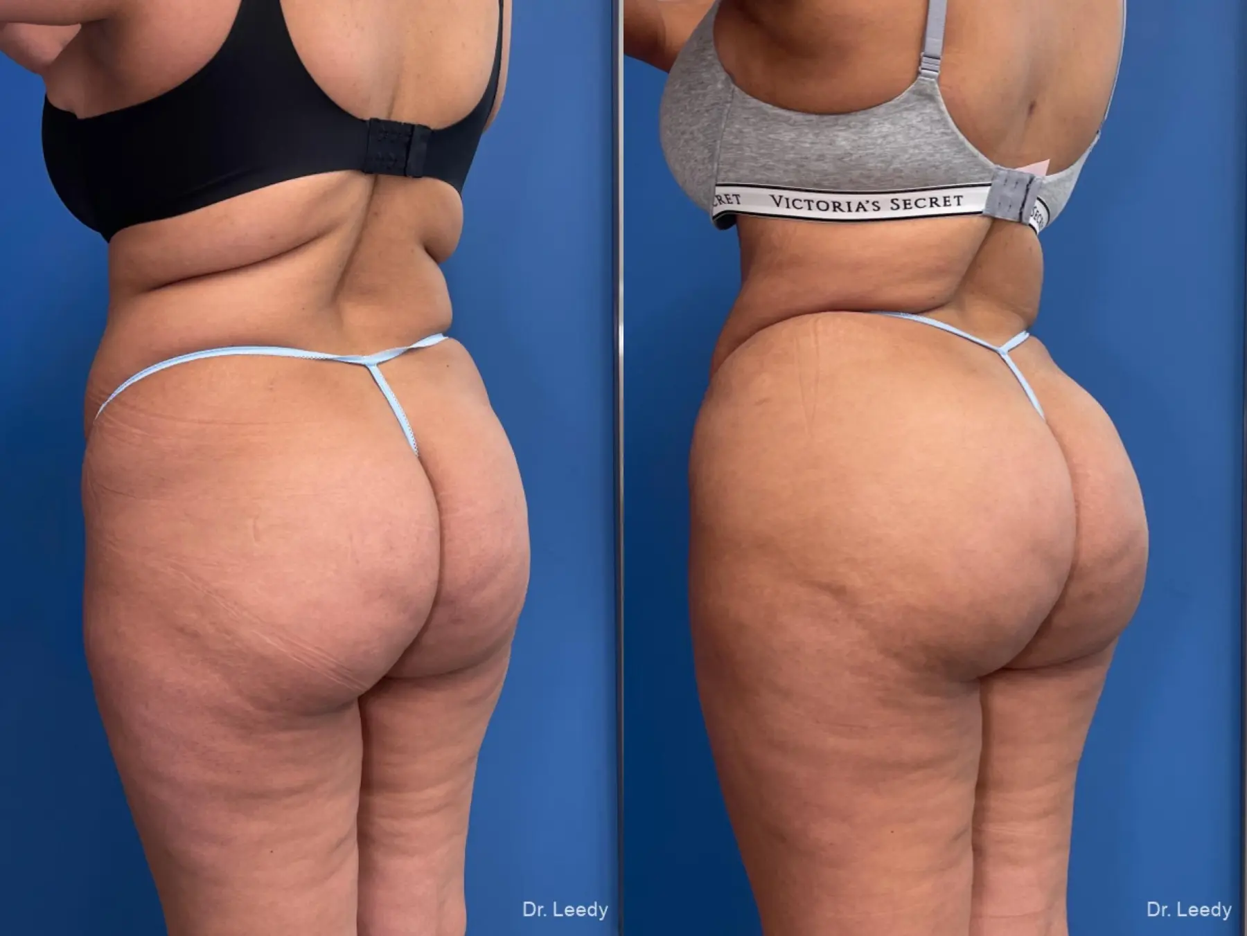 Brazilian Butt Lift: Patient 6 - Before and After  