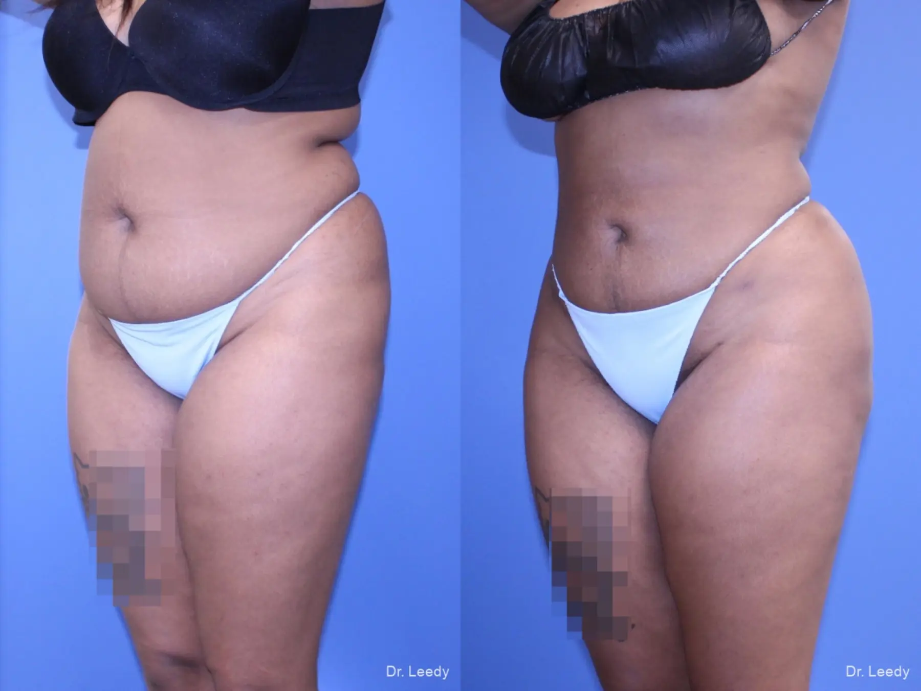 Brazilian Butt Lift: Patient 5 - Before and After 4