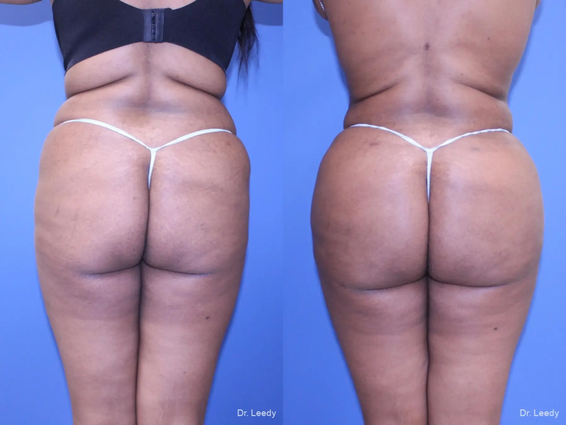 Brazilian Butt Lift: Patient 5 - Before and After  