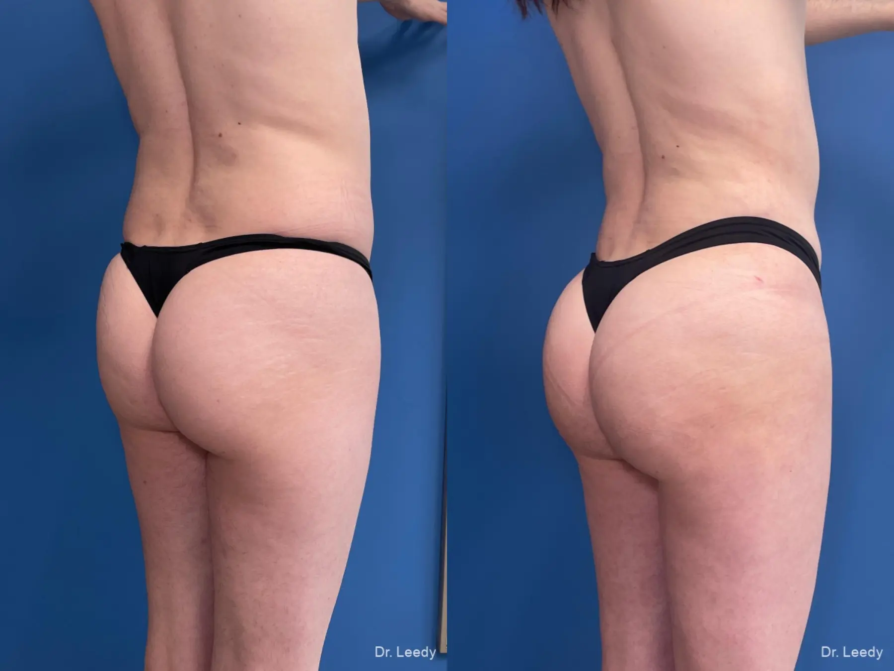 Brazilian-butt-lift-for-men: Patient 1 - Before and After  