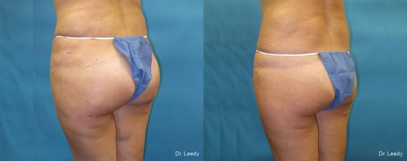 Brazilian Butt Lift: Patient 3 - Before and After 4