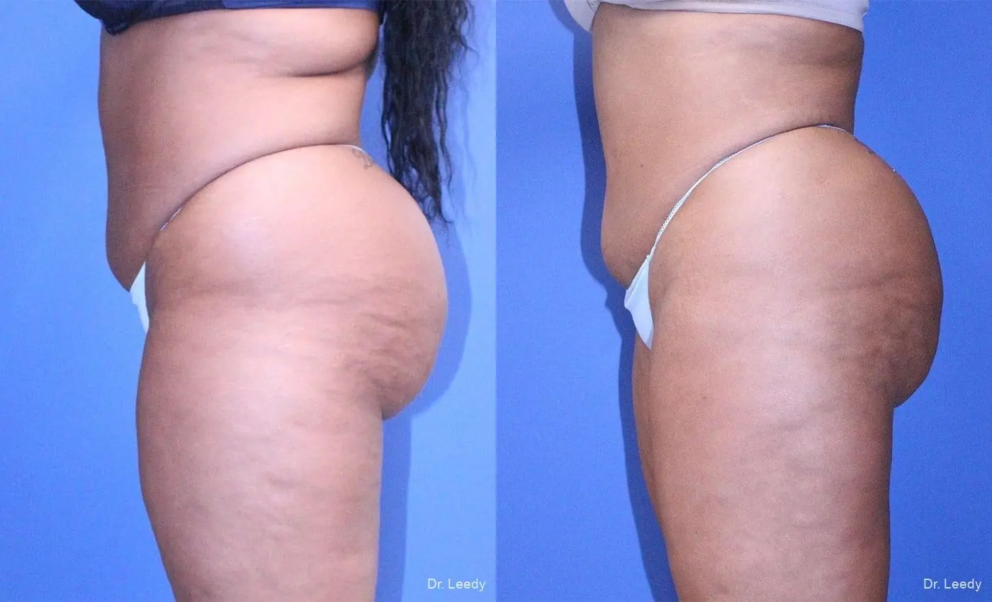Brazilian Butt Lift: Patient 5 - Before and After 7