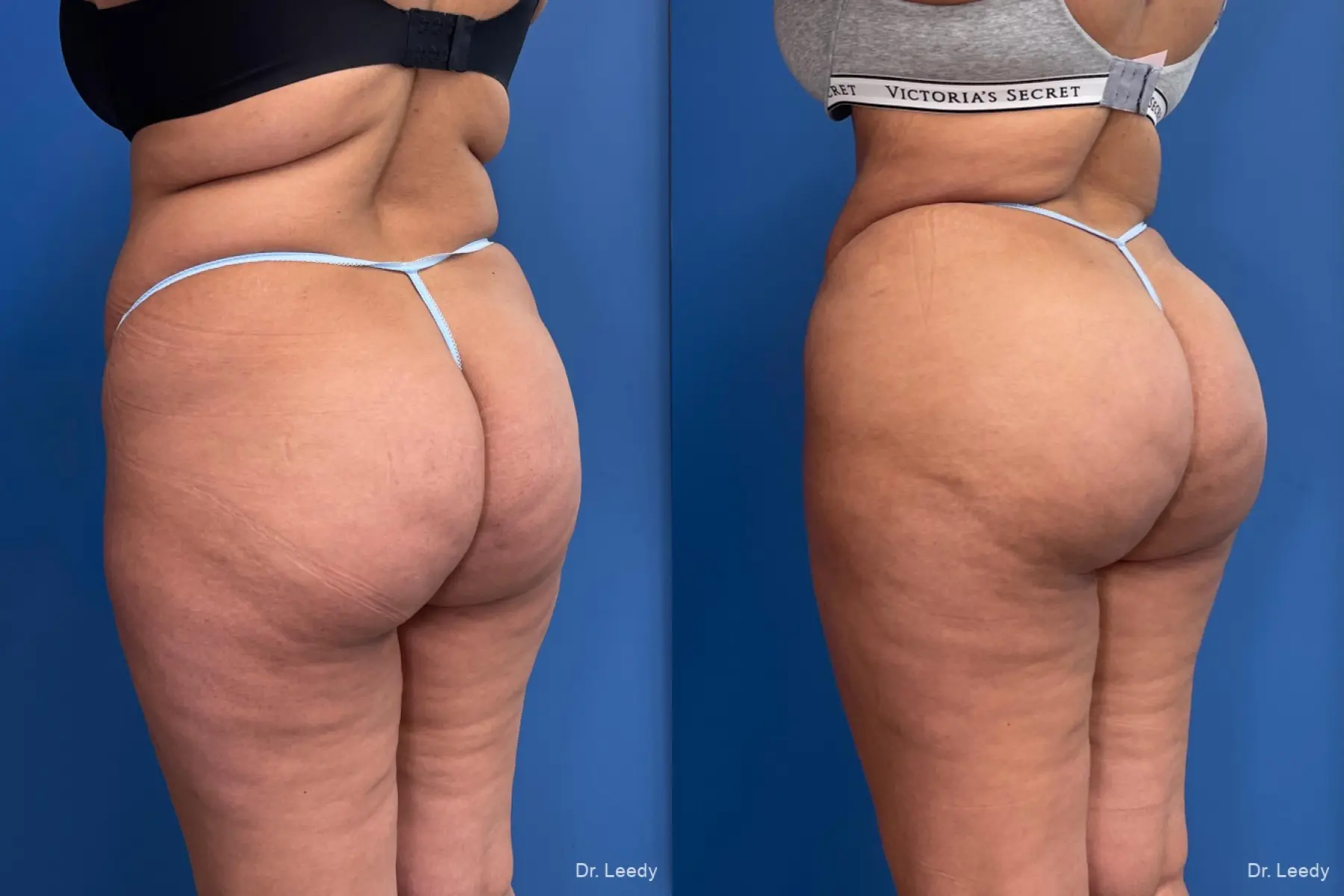 Brazilian Butt Lift: Patient 2 - Before and After  