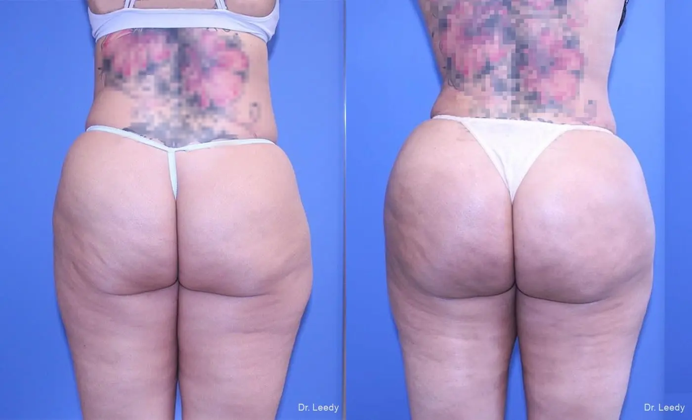 Brazilian Butt Lift: Patient 10 - Before and After  