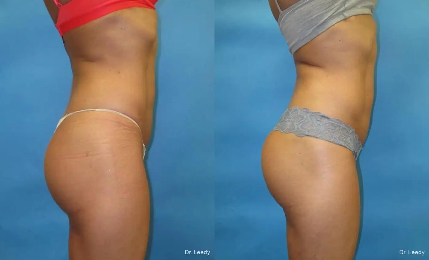 Brazilian Butt Lift: Patient 6 - Before and After 5