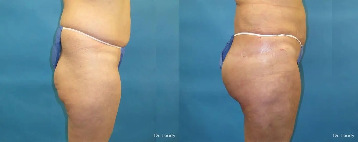 Brazilian Butt Lift: Patient 17 - Before and After 3