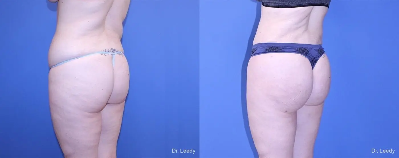 Brazilian Butt Lift: Patient 2 - Before and After 6