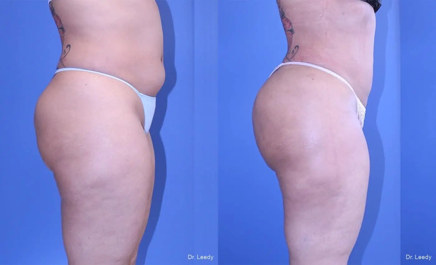 Brazilian Butt Lift: Patient 9 - Before and After 5