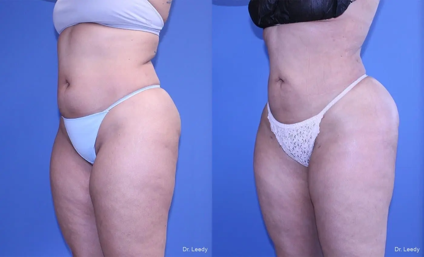 Brazilian Butt Lift: Patient 9 - Before and After 6