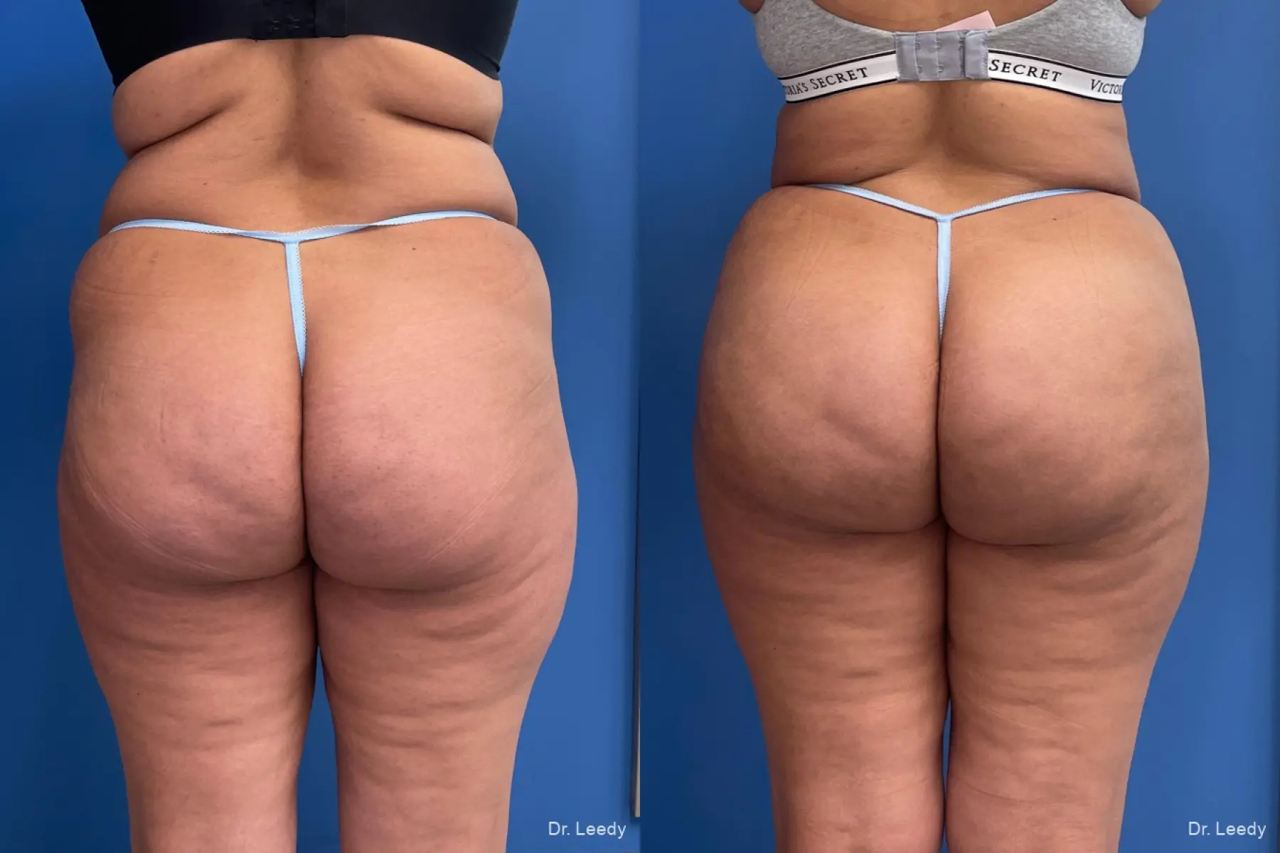 Brazilian Butt Lift: Patient 2 - Before and After 2