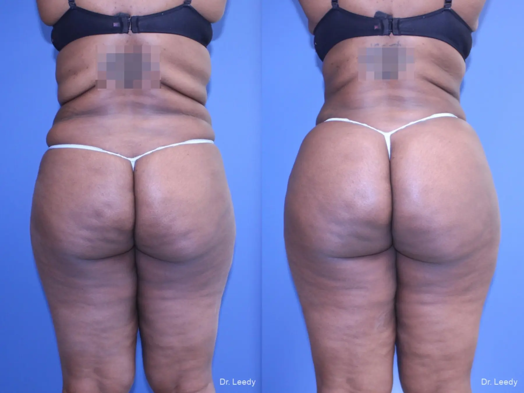 Brazilian Butt Lift: Patient 7 - Before and After  