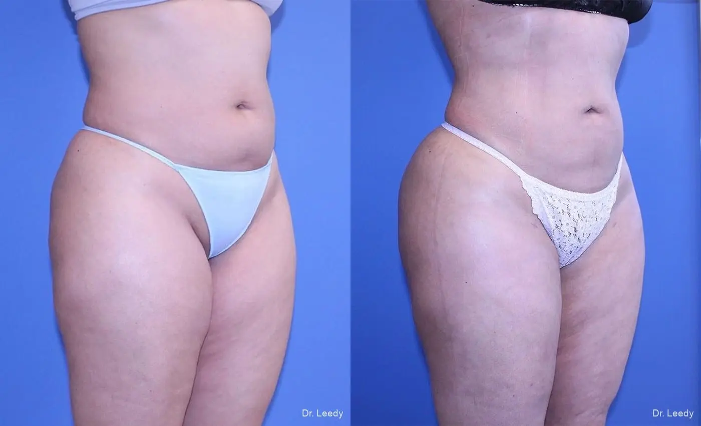 Brazilian Butt Lift: Patient 9 - Before and After 3
