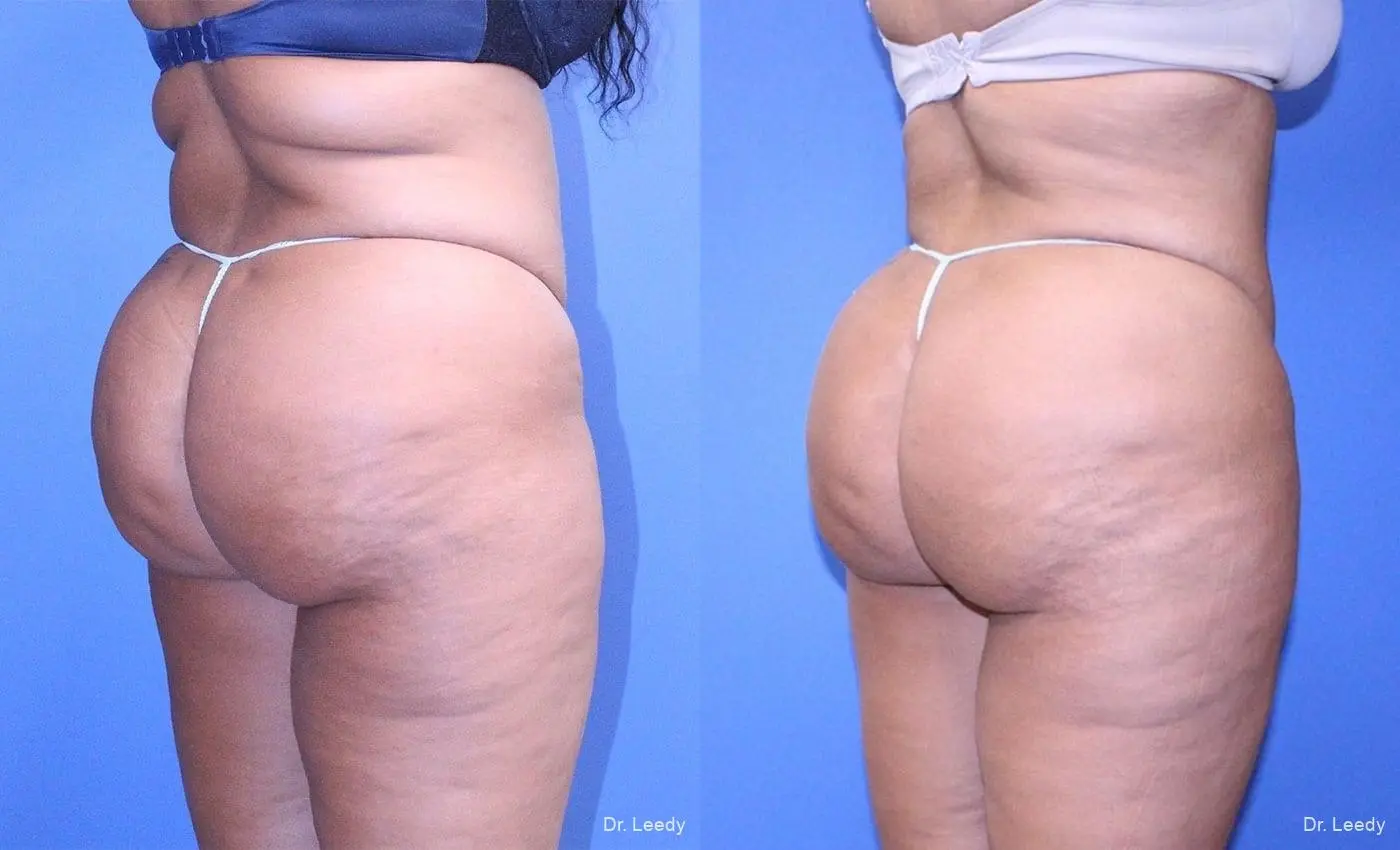 Brazilian Butt Lift: Patient 5 - Before and After 4