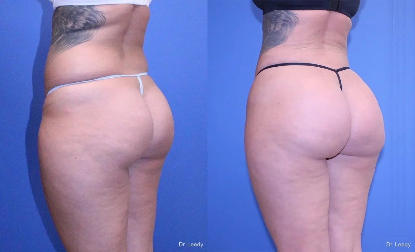 Brazilian Butt Lift: Patient 8 - Before and After 7