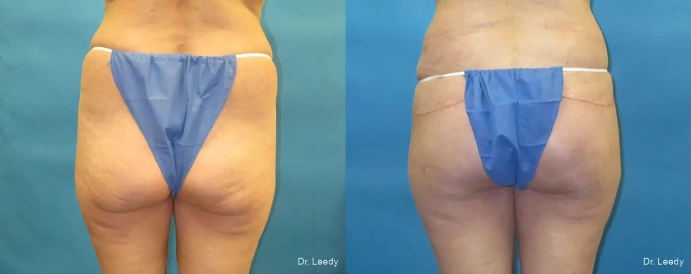 Brazilian Butt Lift: Patient 17 - Before and After 1