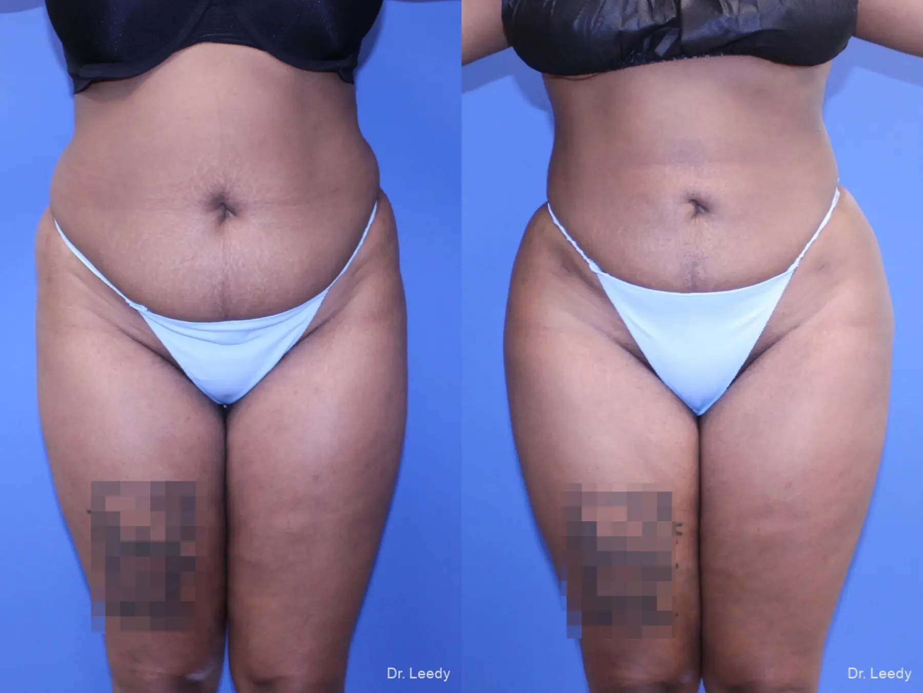 Brazilian Butt Lift: Patient 5 - Before and After 5