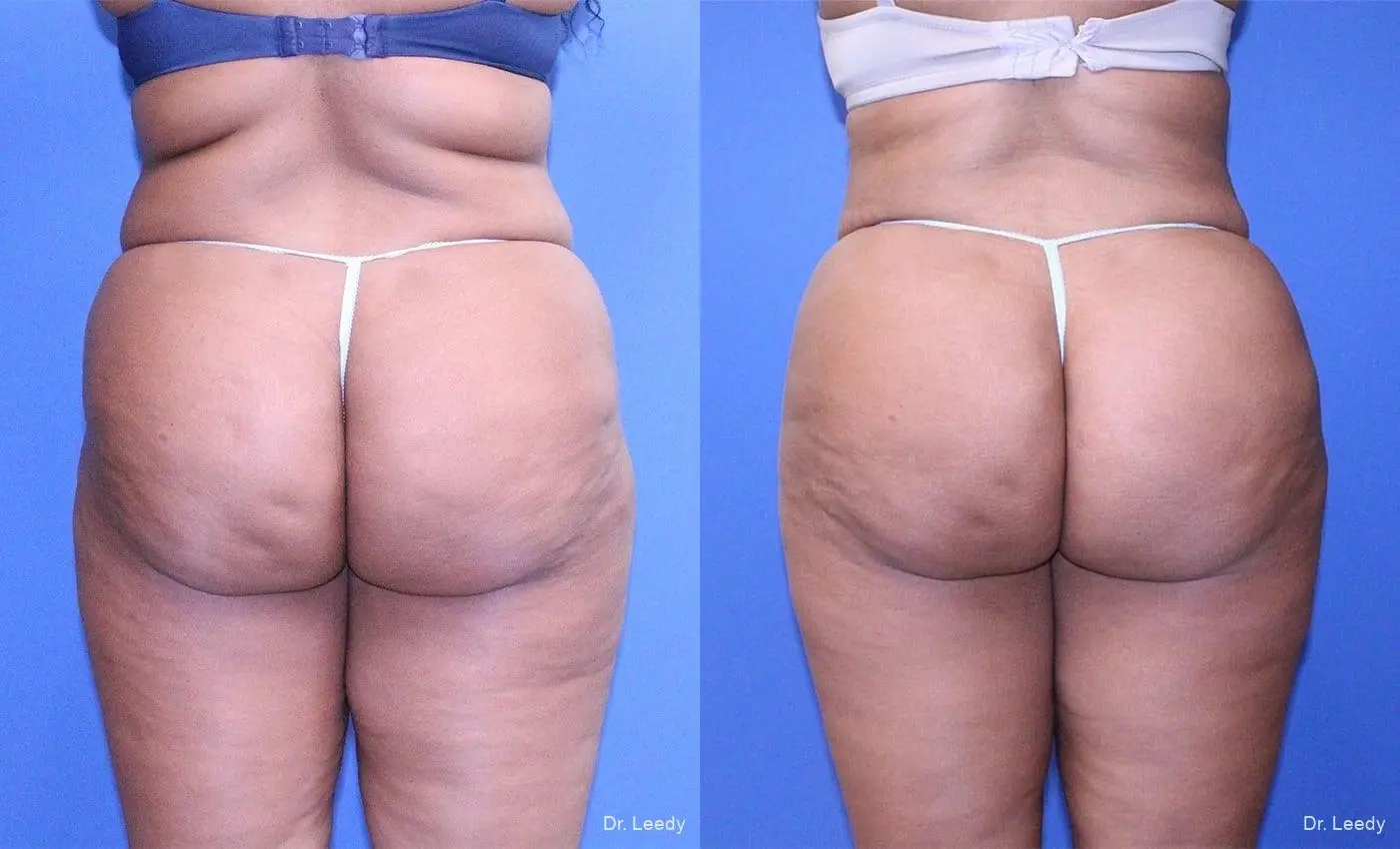 Brazilian Butt Lift: Patient 14 - Before and After  