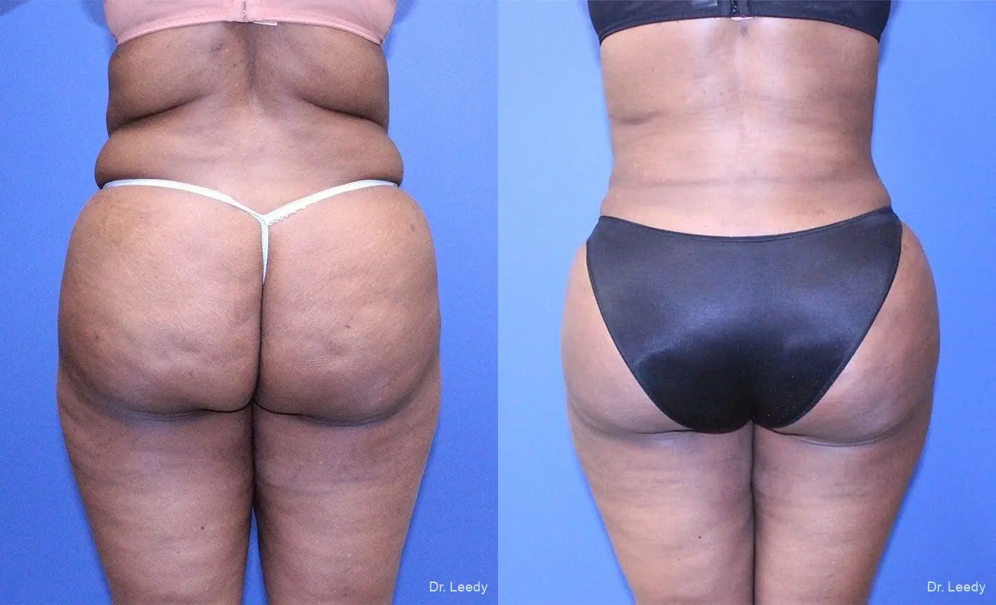 Brazilian Butt Lift: Patient 7 - Before and After 1