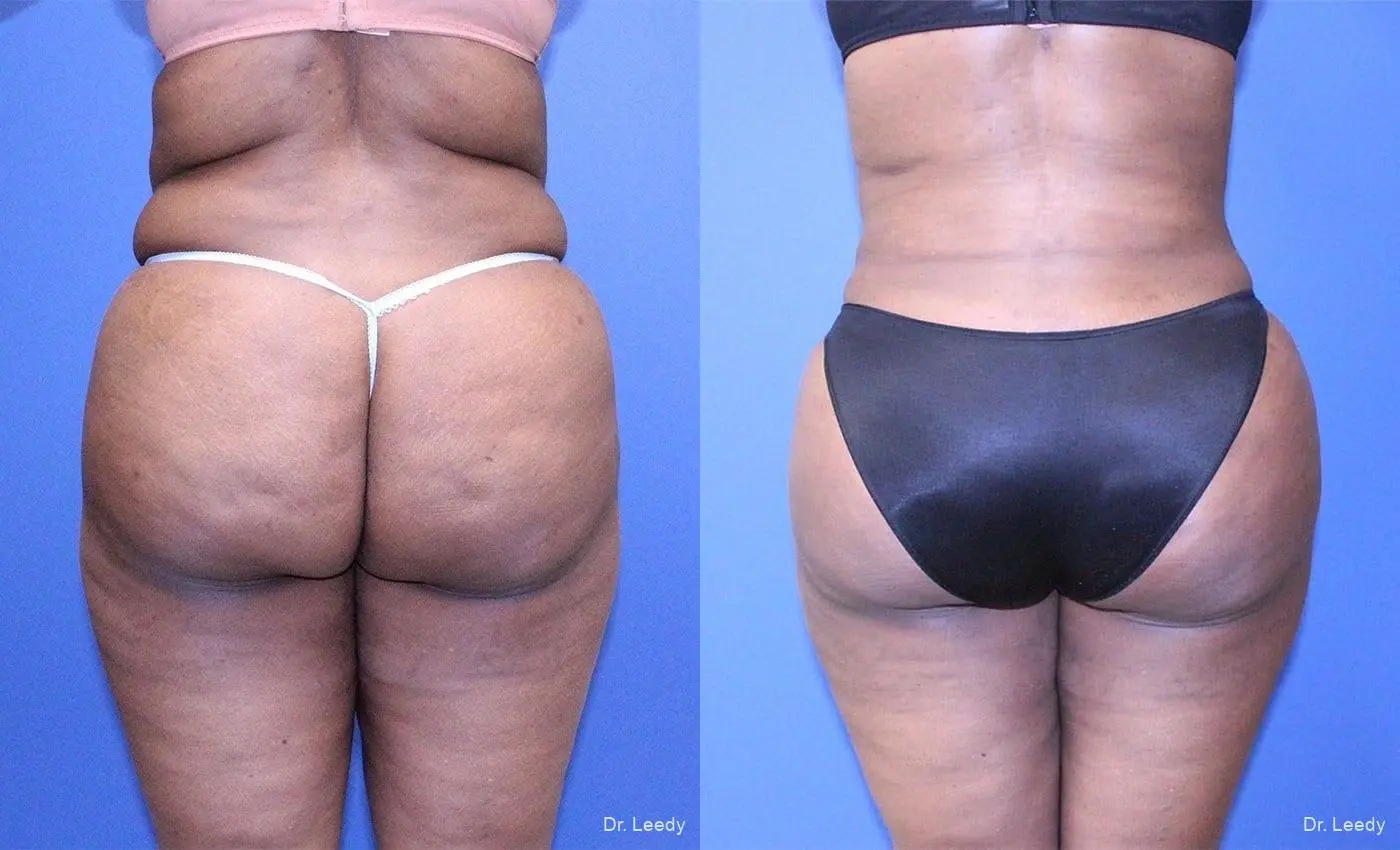 Brazilian Butt Lift: Patient 13 - Before and After  