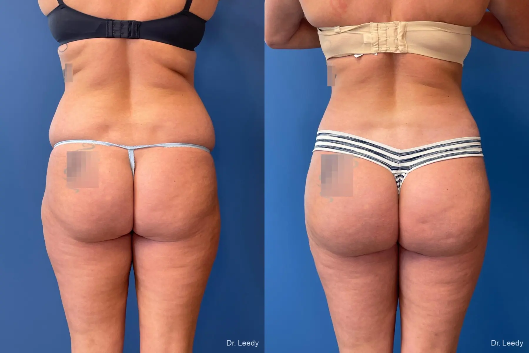 Brazilian Butt Lift: Patient 8 - Before and After  