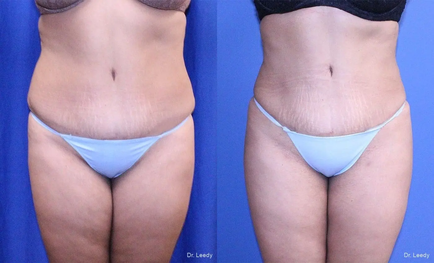 Brazilian Butt Lift: Patient 4 - Before and After 2