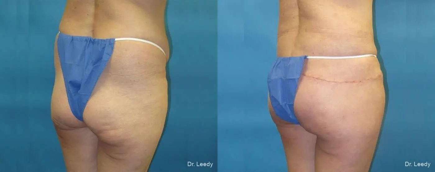Brazilian Butt Lift: Patient 17 - Before and After 2