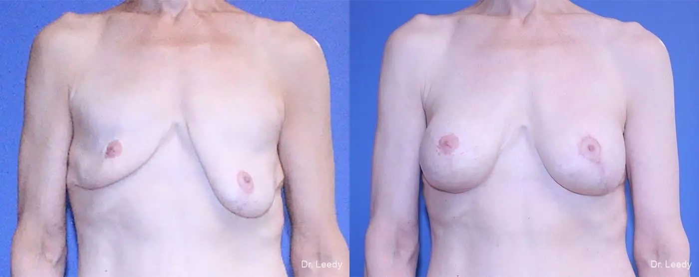 Breast Asymmetry: Patient 1 - Before and After  
