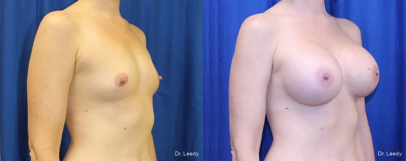 Breast Augmentation: Patient 8 - Before and After 2