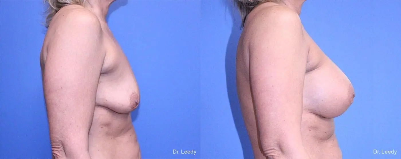 Breast Augmentation: Patient 8 - Before and After 3