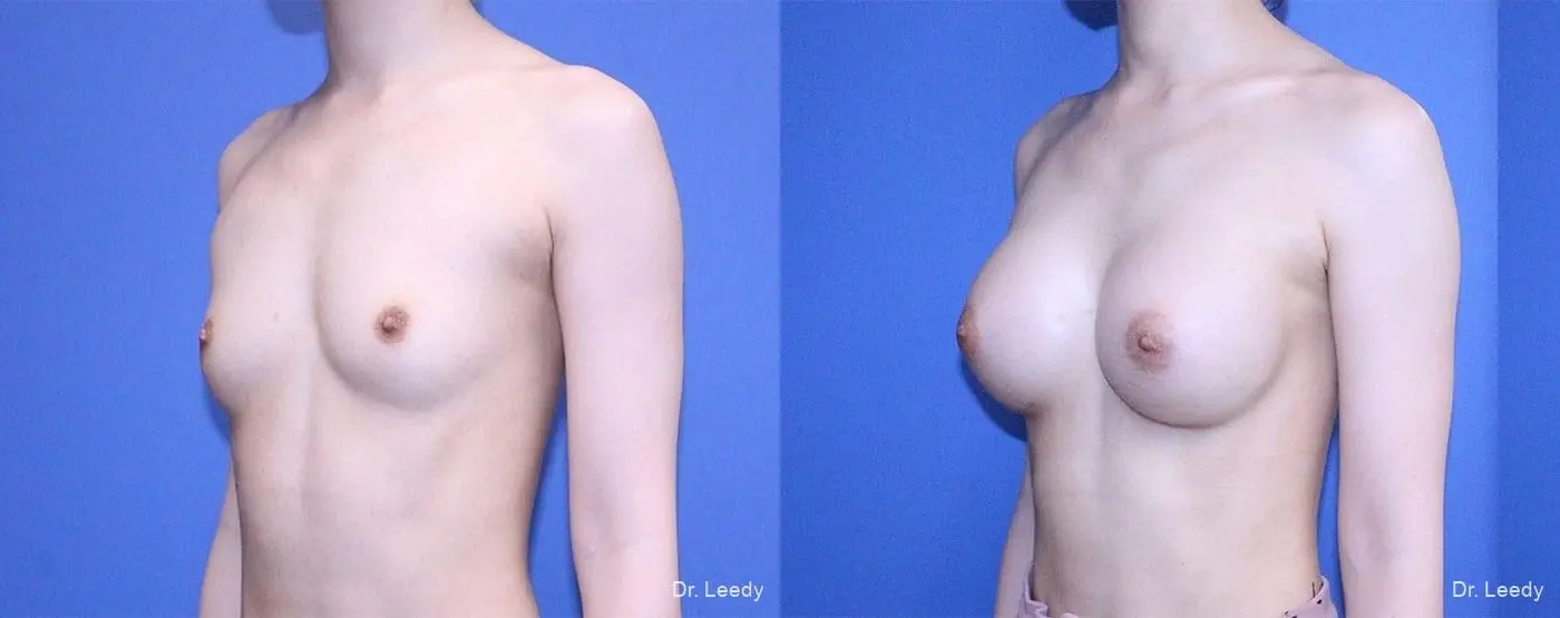 Breast Augmentation: Patient 4 - Before and After 4