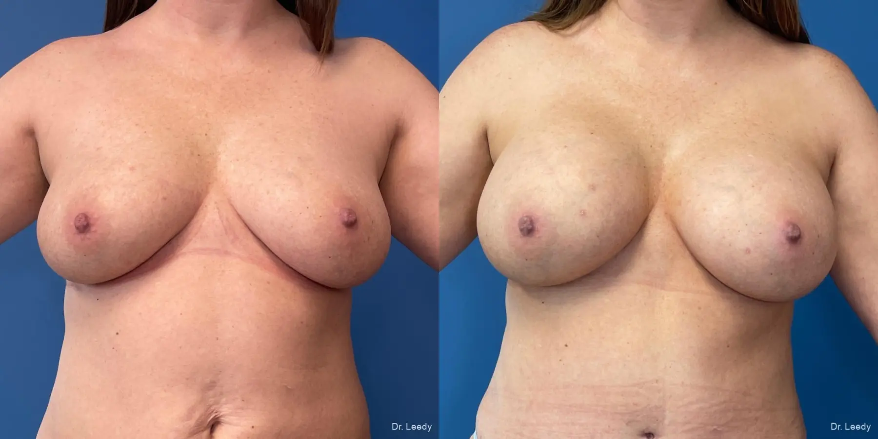 Breast Augmentation: Patient 15 - Before and After  