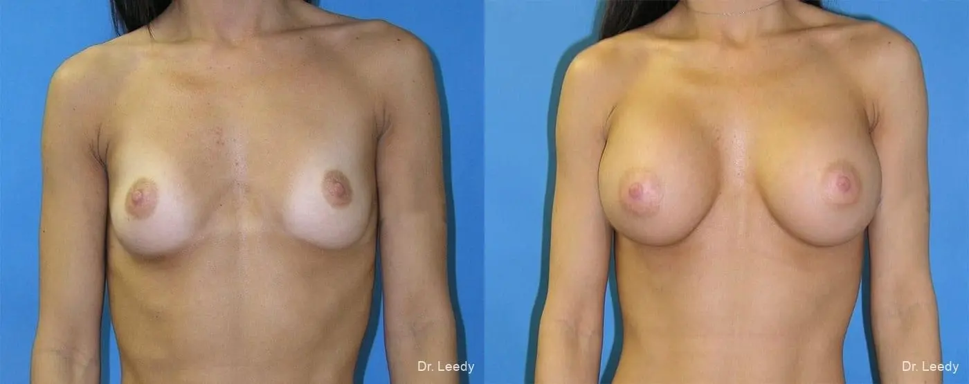 Breast Augmentation: Patient 7 - Before and After  