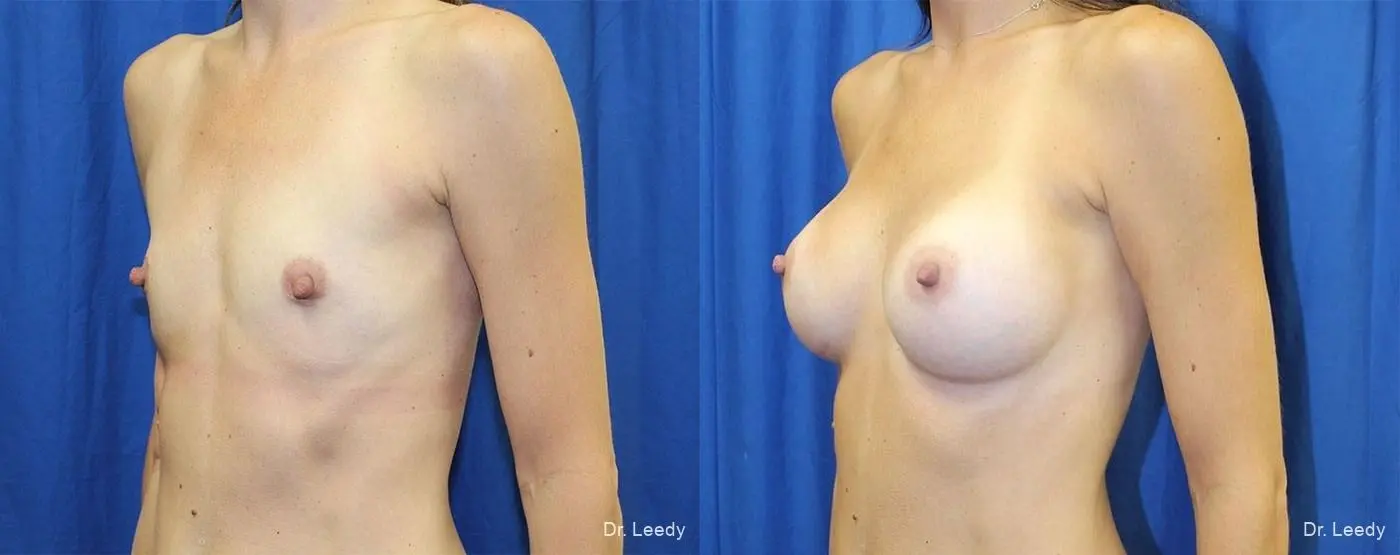 Breast Augmentation: Patient 2 - Before and After 4