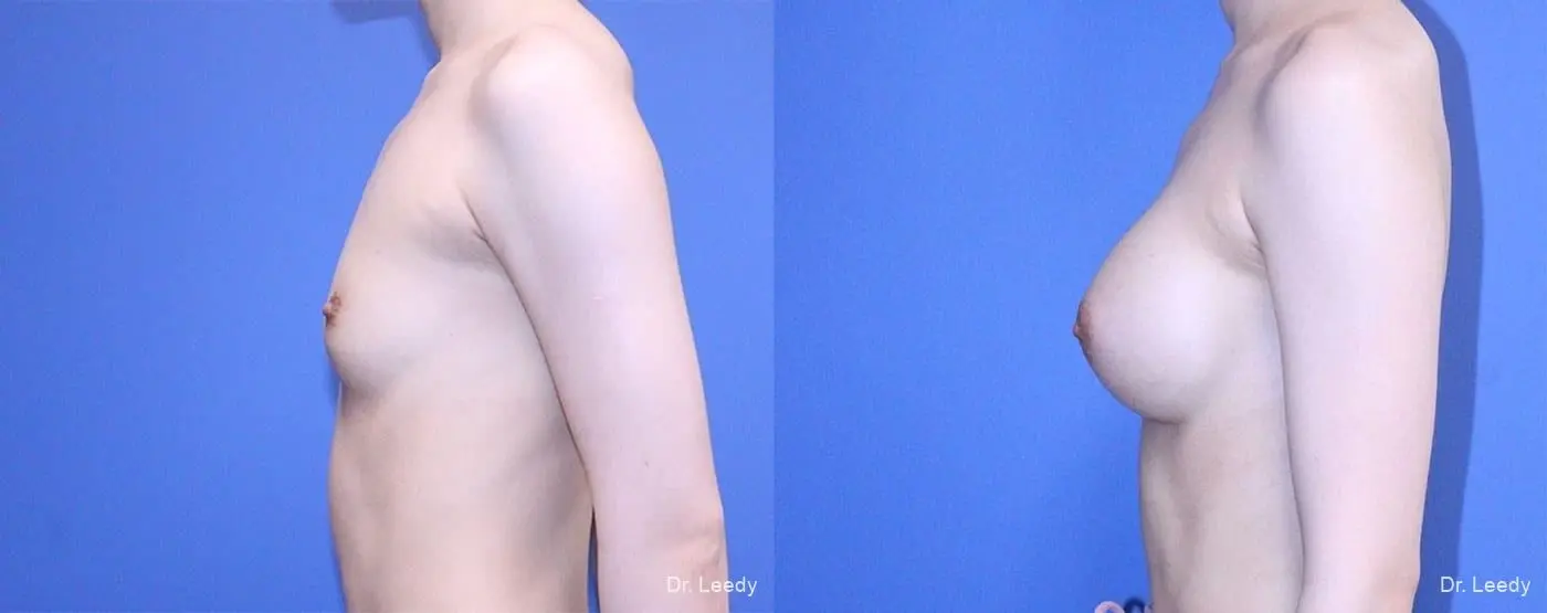 Breast Augmentation: Patient 2 - Before and After 5