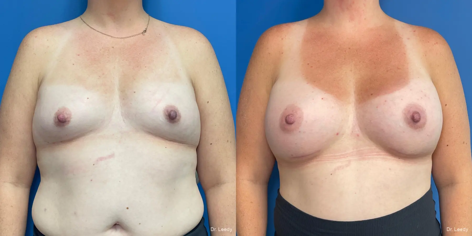 Breast Augmentation: Patient 20 - Before and After  