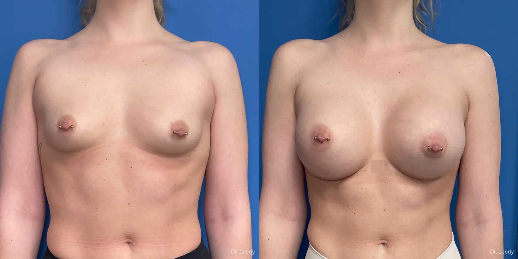 Breast Augmentation: Patient 21 - Before and After  