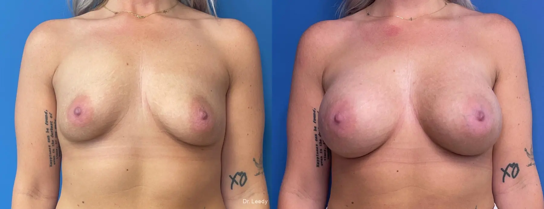 Breast Augmentation: Patient 13 - Before and After  