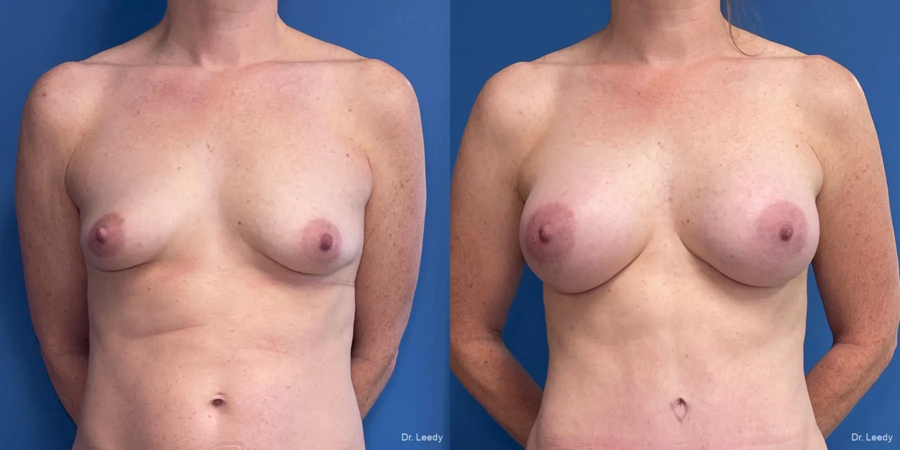 Breast Augmentation: Patient 17 - Before and After  