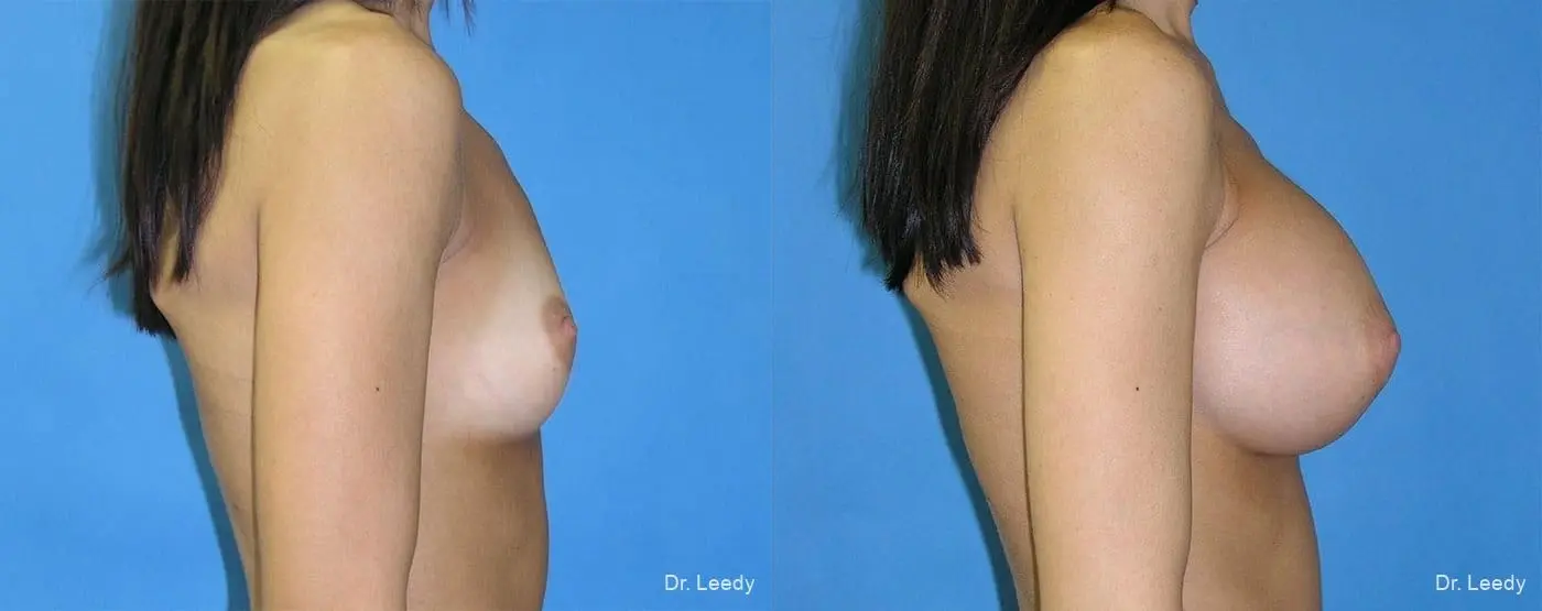Breast Augmentation: Patient 7 - Before and After 3