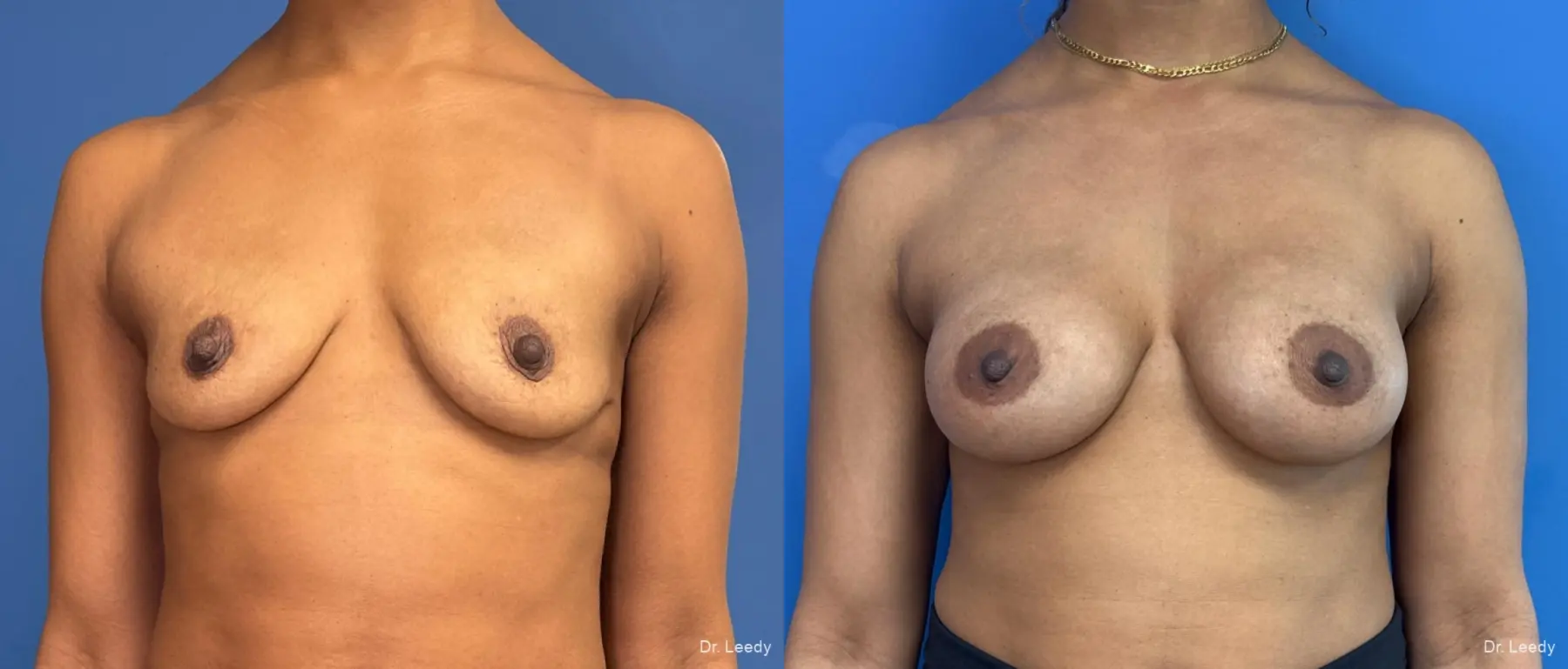 Breast Augmentation: Patient 40 - Before and After  