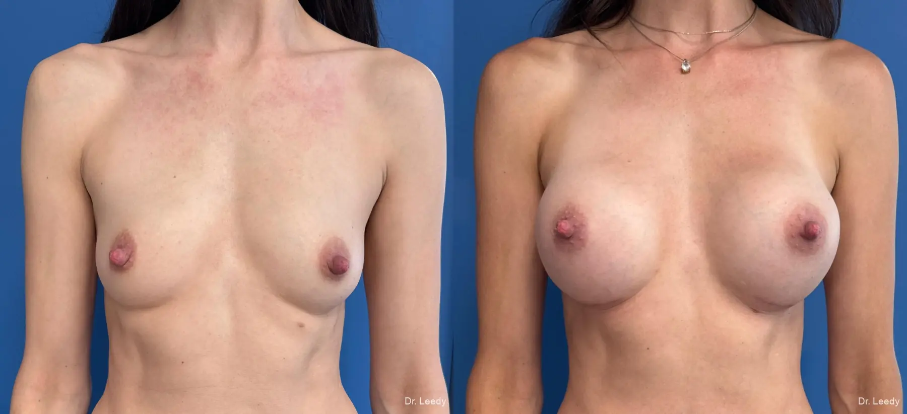 Breast Augmentation: Patient 39 - Before and After  