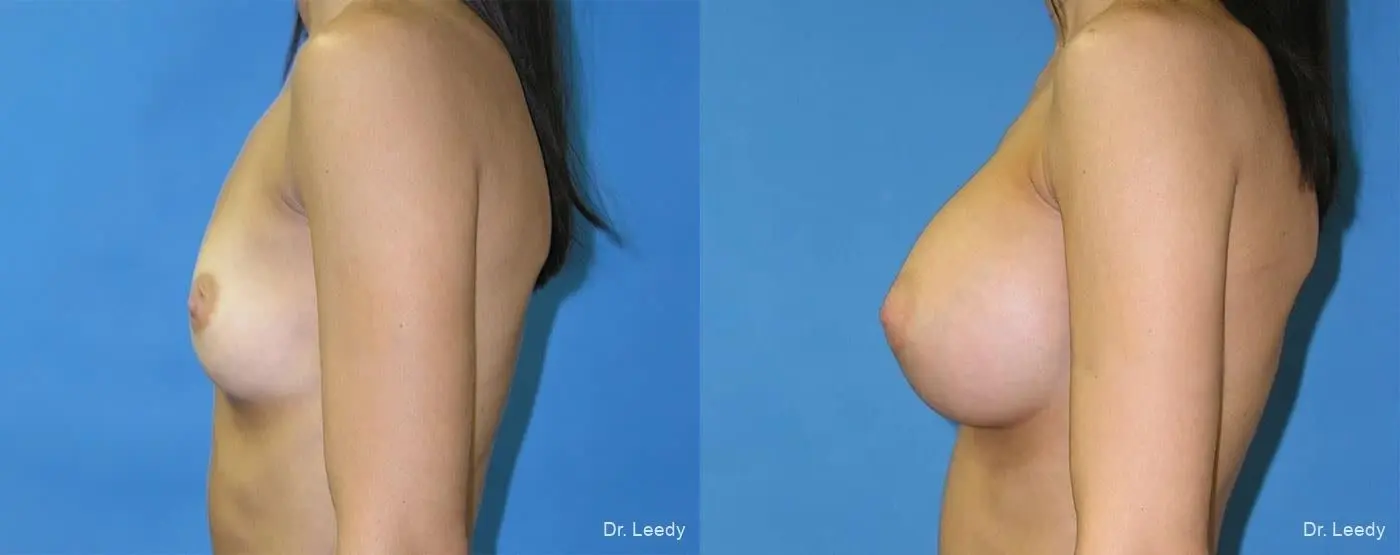 Breast Augmentation: Patient 7 - Before and After 5