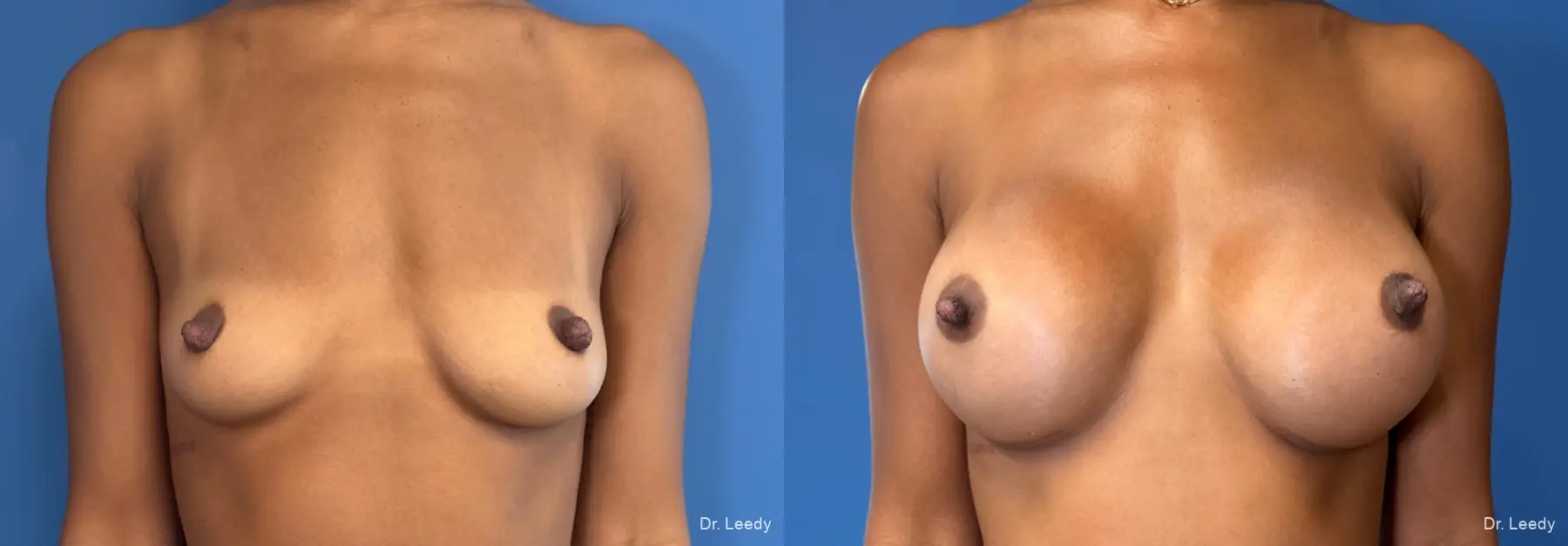 Breast Augmentation: Patient 37 - Before and After  